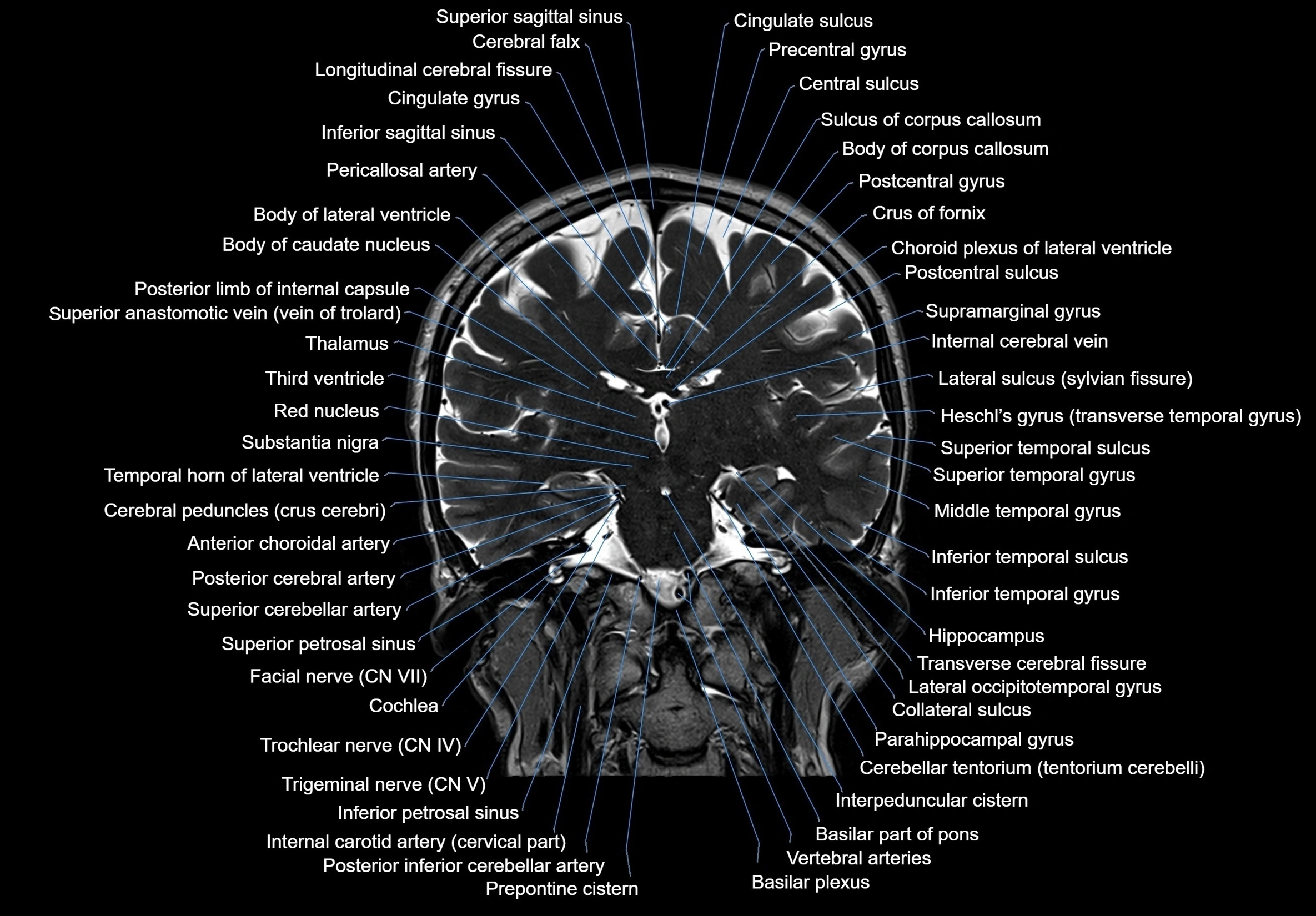 MRI Brain coronal cross sectional labelled anatomy 3T image  -img-00001-00042.webp